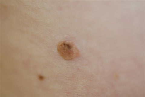 seborrheic keratosis hard skin