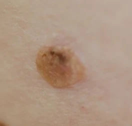 dark spot on skin seborrheic keratosis