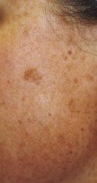 fight sun spots with diy skin care