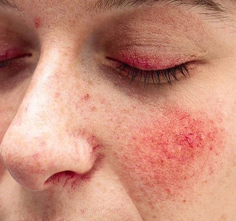 spider veins on face from rosacea picture