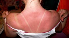 Use sunscreen protection to avoid a burn!