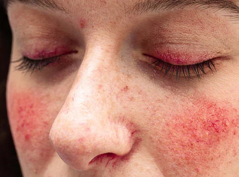 what is acne rosacea