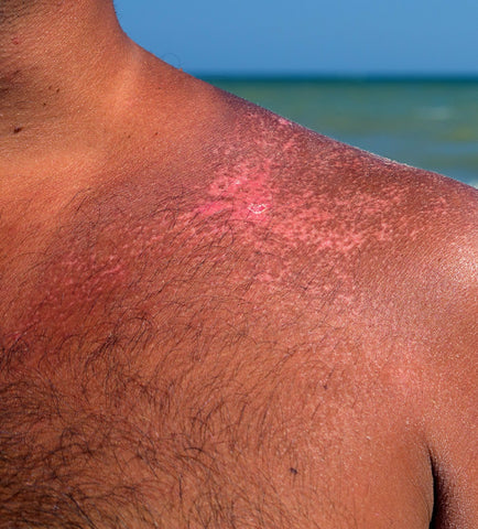 what not to do to sunburned skin