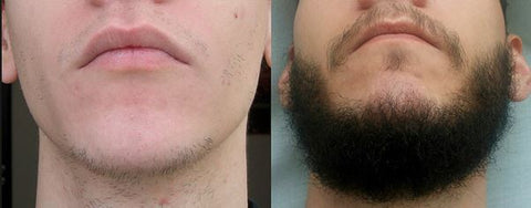 Antes e depois resultado minoxidil 1 ano na barba