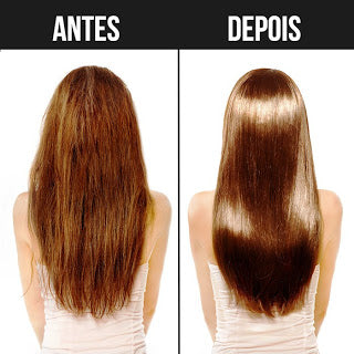 antes-e-depois-do-botox