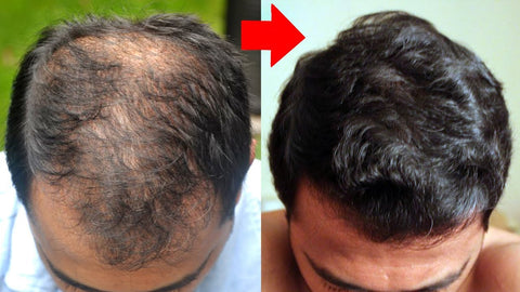antes-e-depois-minoxidil-no-cabelo