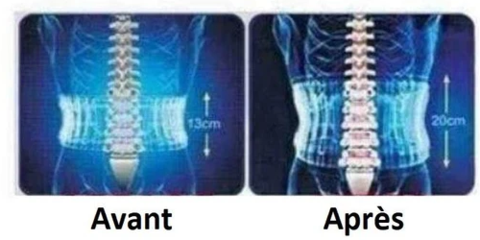 antes después cinturón de descompresión lumbar