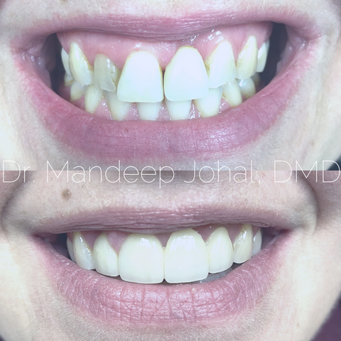 Guelph Smile Makeover Dentist Before and After