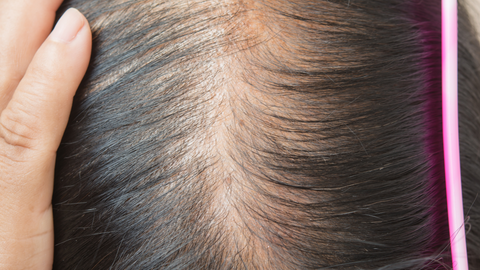 women with thin hair focused on scalp
