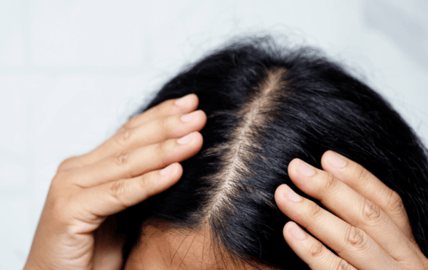 a woman suffering from scalp irritation