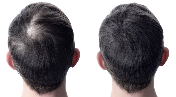 Before and after photo of a man with thinning hair on the crown of his head.