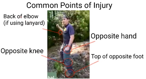 Common points of machete injury
