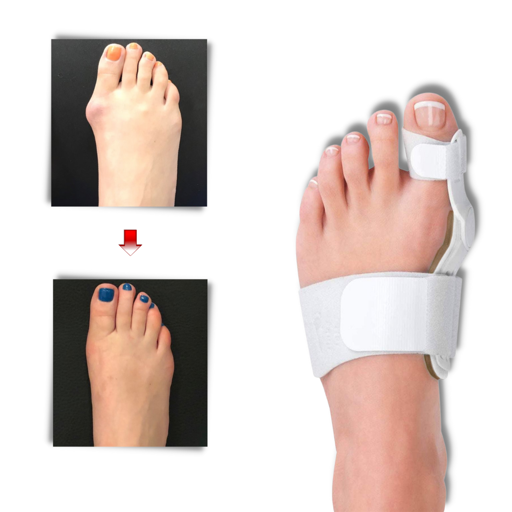 Ortopedisk Hallux valgus-stöd - Smärtlindring - Ozerty