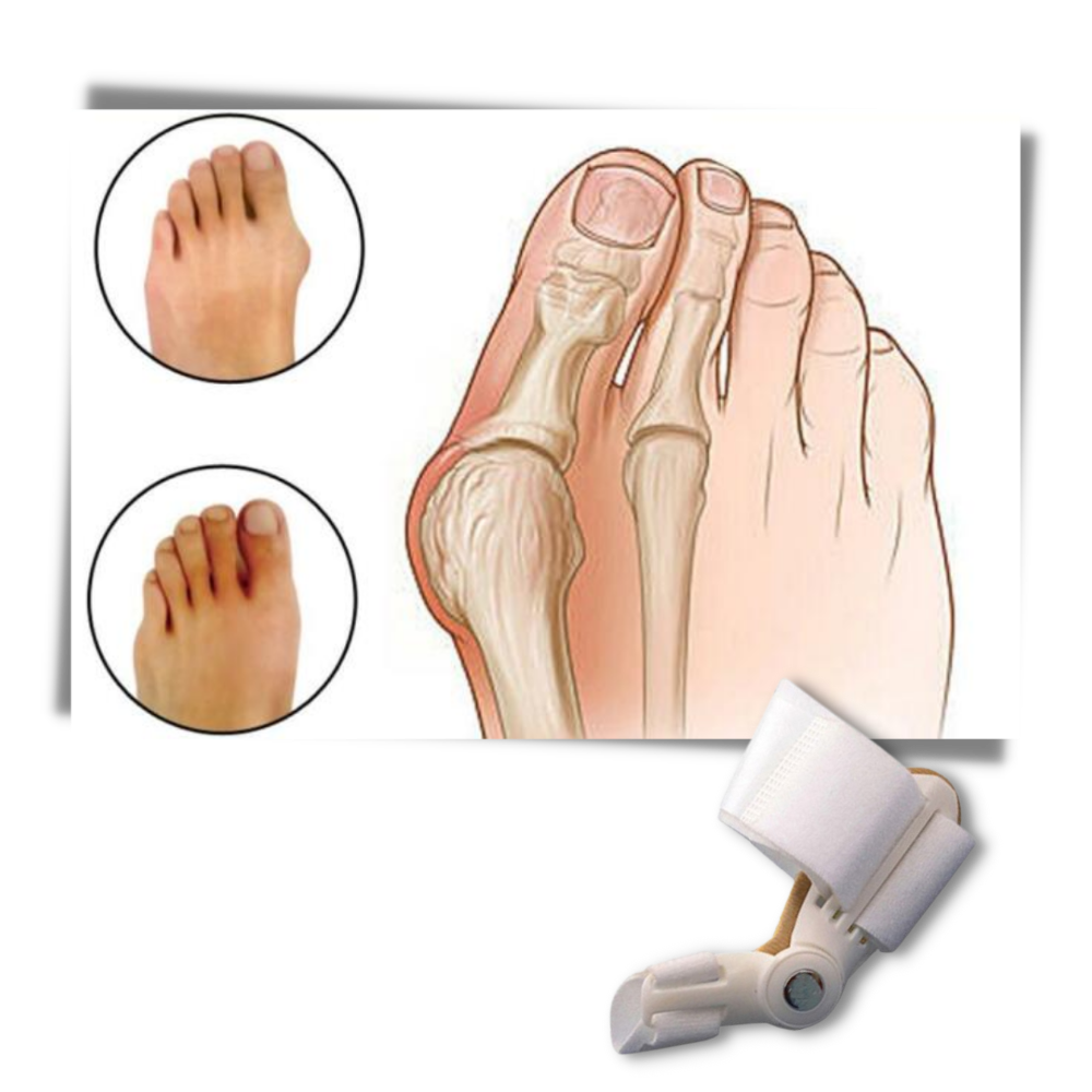 Correcteur d'oignon au pied orthopédique  - Matériau flexible - Ozerty