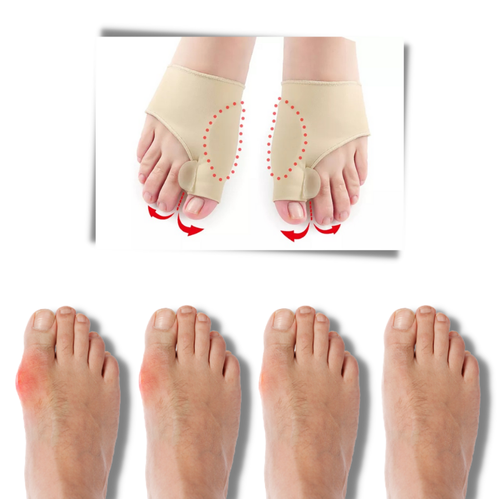 Correcteur d'oignons de pieds en gel - Confortable et facile à utiliser - Ozerty