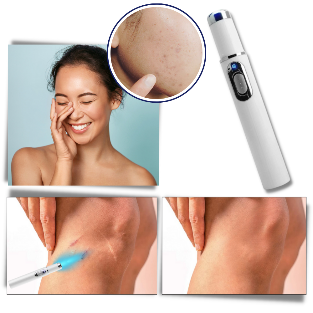  Dark Spot Remover Blue Laser Pen - Ozerty