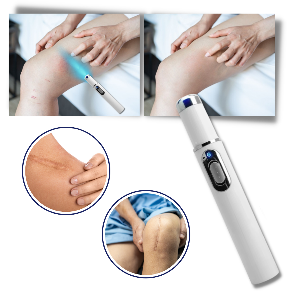 Penna laser blu per la rimozione delle macchie scure - Riduzione efficace delle cicatrici - Ozerty