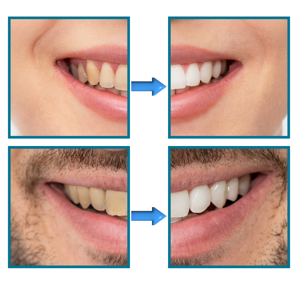 Quick Stain Removal Teeth Whitening - Results You Can See - Ozerty