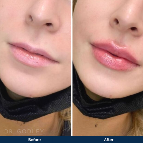 russian lip filler abbotsford before and after