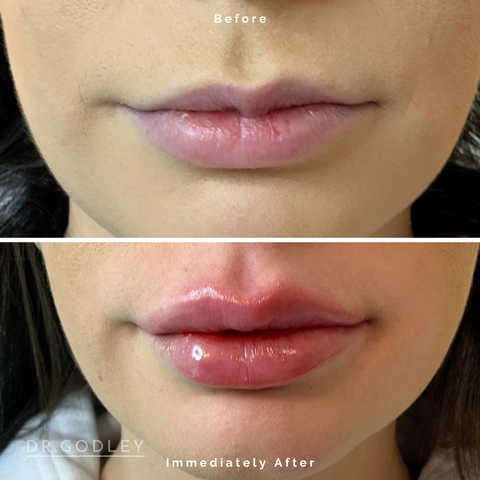 Russian lip filler abbotsford before and after