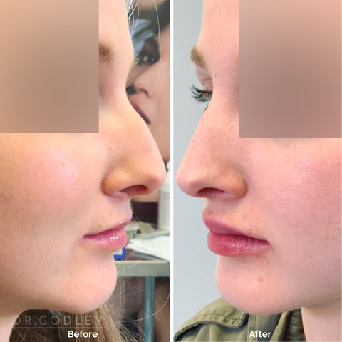 nose thread lift before and after