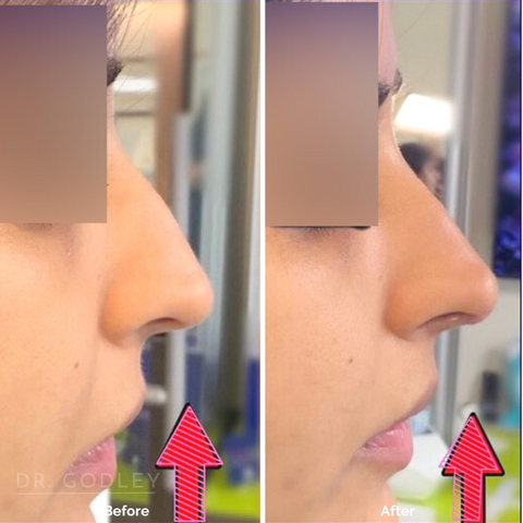 nose thread lift before and after
