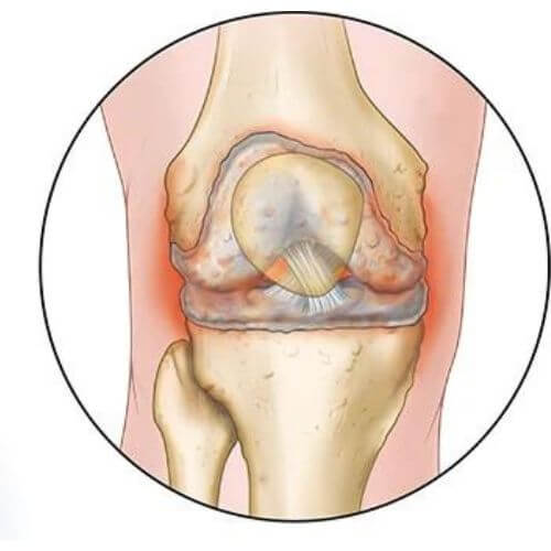 Osteoarthiritis