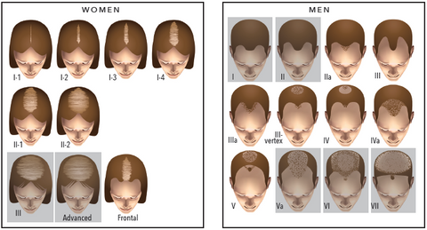 Hair Loss Patterns - Women - I-1, I-2, I-3, I-4, II-1, II-2, III, Advanced, Frontal. Men I, II, IIa, III, IIIa, III-vertex, IV, IVa, V, Va, VI, VII