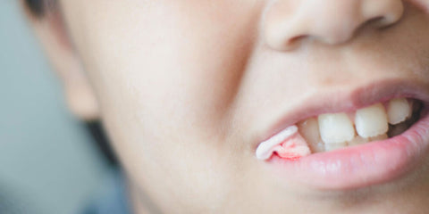 Blanqueamiento Dental y Extracción Dental