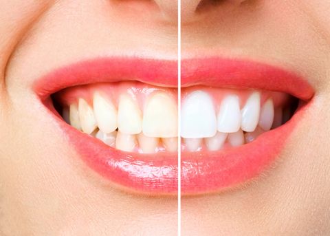 Imagen de una mujer sonriendo y mostrando con confianza sus dientes blancos, demostrando los resultados del blanqueamiento dental.