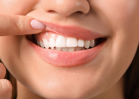 woman showing whitening teeth