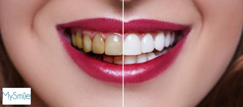 mujeres-sonriendo-con-dientes-blancos