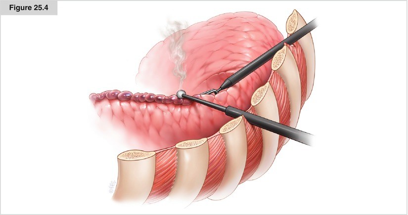 bullectomy surgery