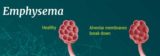 emphysema image