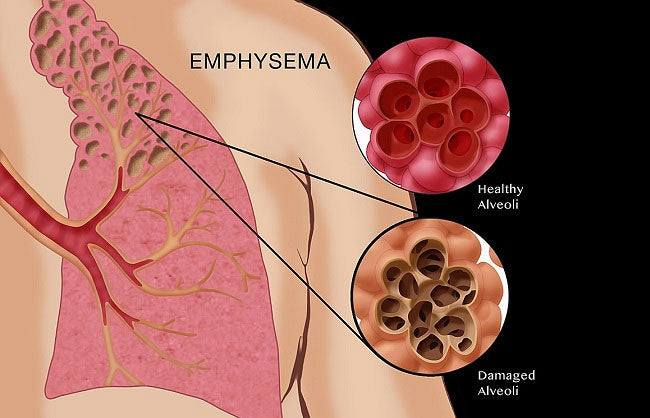 emphysema-and-copd