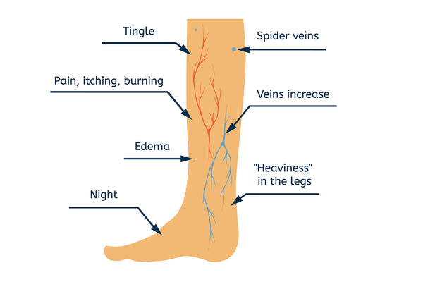 Chronic Venous Insufficiency - SVI: Image Of Leg Illustrating Common Symptoms Felt By Patient