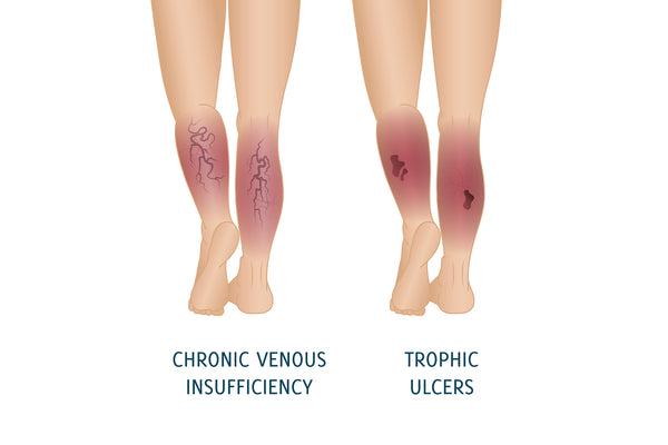 Image Of 2 Patients Legs Illustrating Venous Ulcers And Other Complications Caused By Chronic Venous Insufficiency