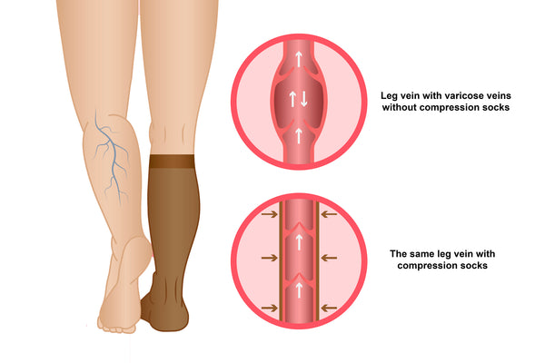 Image Showing Benefits Of Wearing Compression Socks For Leg With Varicose Veins Vs Without Them