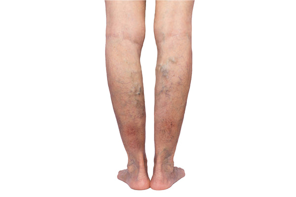 Legs With Chronic Insufficiency Signs - Varicose Veins and Venous Ulcers