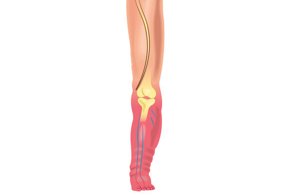 Leg With Deep Vein Thrombosis - DVT - Illustration