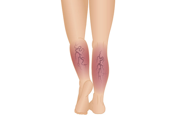 Leg With Phlebitis in The Calves - Image Showing Back Of Lower Limbs