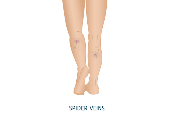 Spider Veins - Illustration Of Legs With Spider Vein At Both Calves