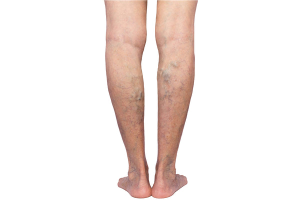 Legs Showing Varicose Veins in Calves - Illustration