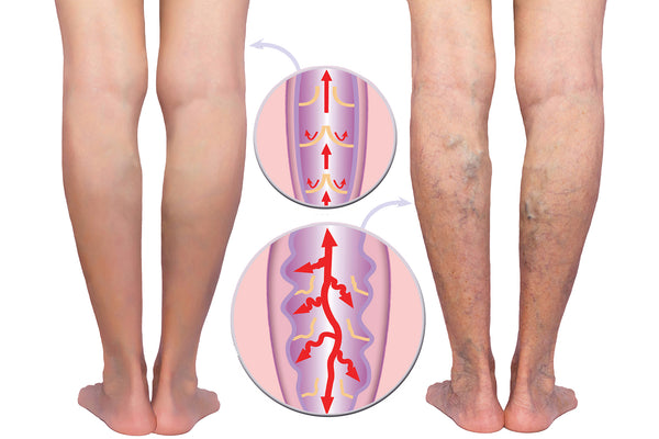 Image Showing Leg With Venous Insufficiency Vs A Healthy Leg
