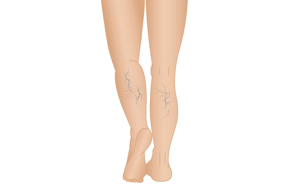 Illustration Of Two Legs Showing Some Varicose Veins On The Calves