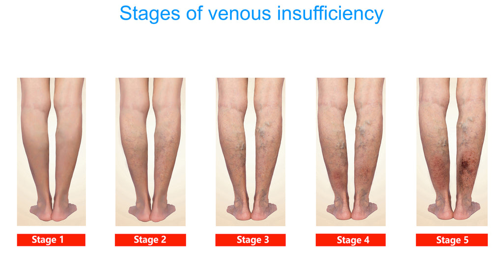 Stages Of Venous Insufficiency - CVI - illustrated On Real Human Legs