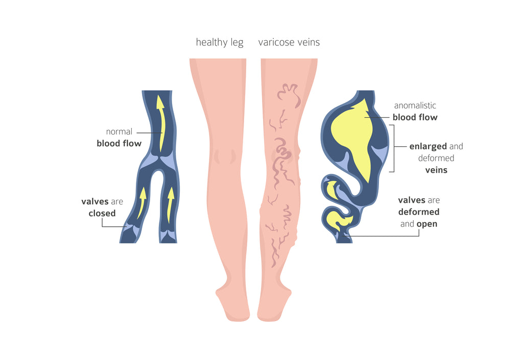 Varicose Vein Leg vs Healthy Leg - Close Look On Vein Valve And Venous Wall