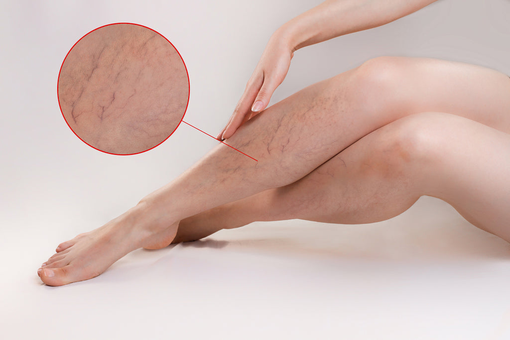 Varicose Veins Showing On Real Women Leg - With Zooming