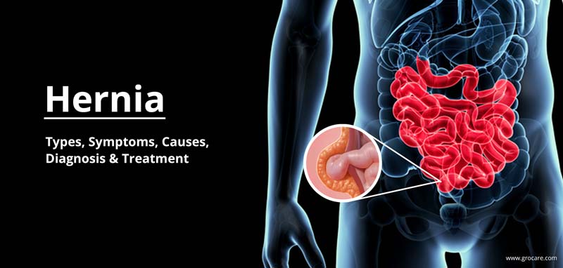Hernia Types Symptoms Causes Diagnosis And Treatment Grocare® India