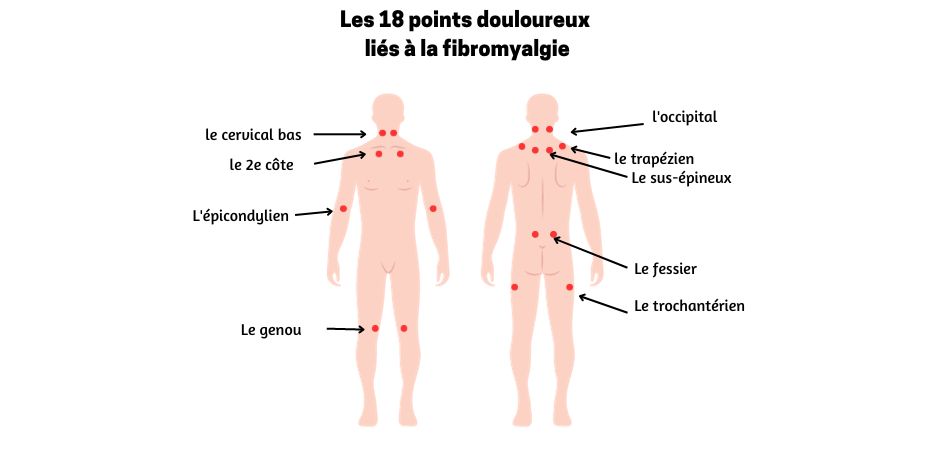 Comment soulager les 18 points douloureux de la fibromyalgie ...